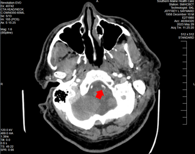 Radiology image showing blood clot at risk of dislodging