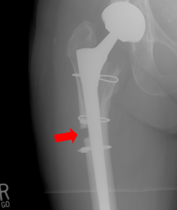 X-ray showing Mary Shea's femur after Dr. Copithorne's negligent operation