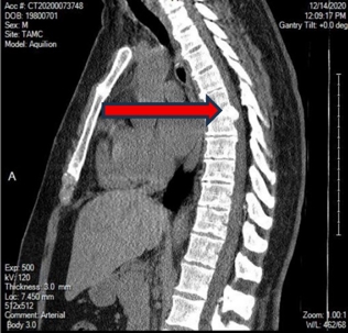 CT scan showing bony calcification that threatened paralysis if untreated