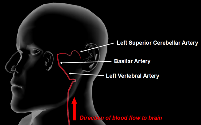 Anatomical diagram showing the clot's pathway