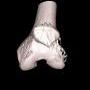 A white 3D-rendered fractured bone is shown against a black background.