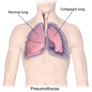 Pneumothorax graphic showing a normal and collapsed lung
