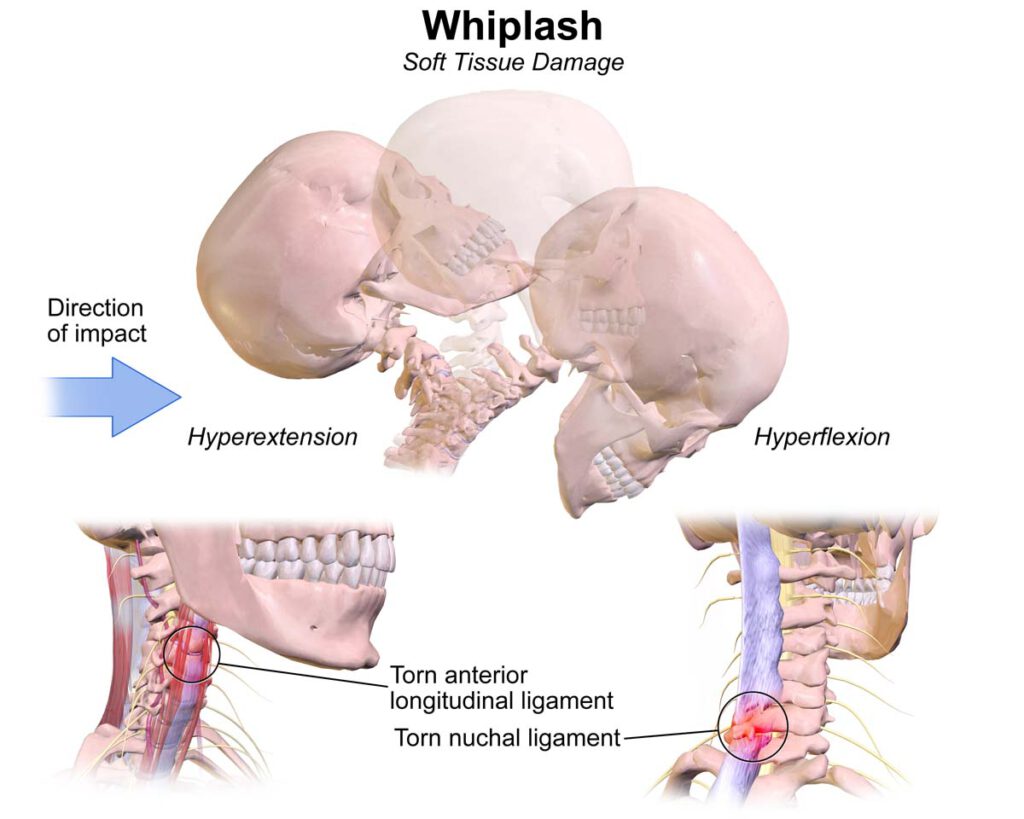 Graphic of soft tissue damage from whiplash