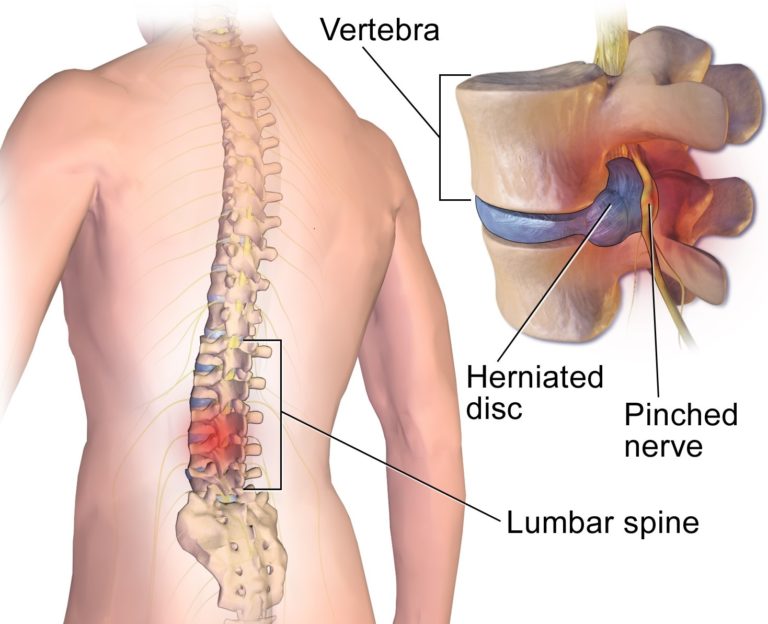 Herninated Disc